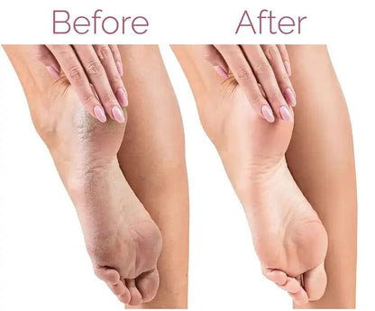 Pro Electric Foot File – USB Rechargeable Callus & Dry Skin Remover