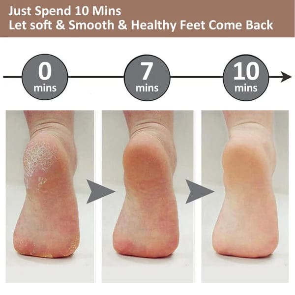 Pro Electric Foot File – USB Rechargeable Callus & Dry Skin Remover